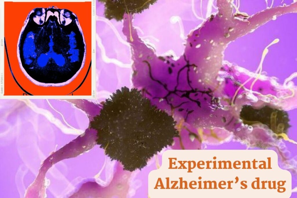 Experimental Alzheimer’s drug