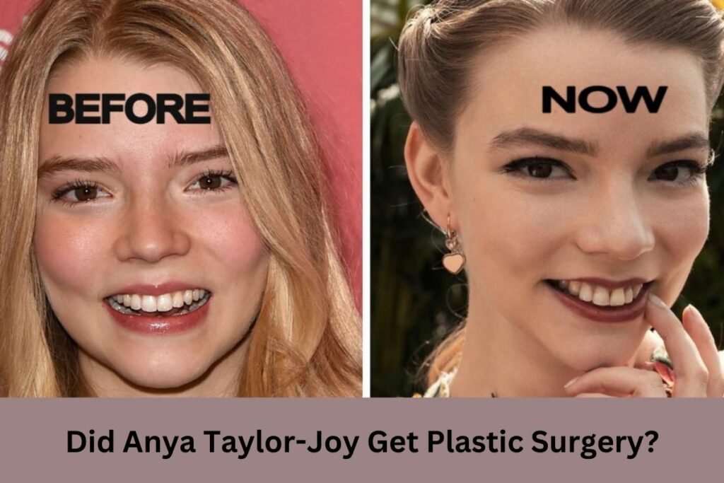 Did Anya Taylor-Joy Get Plastic Surgery?